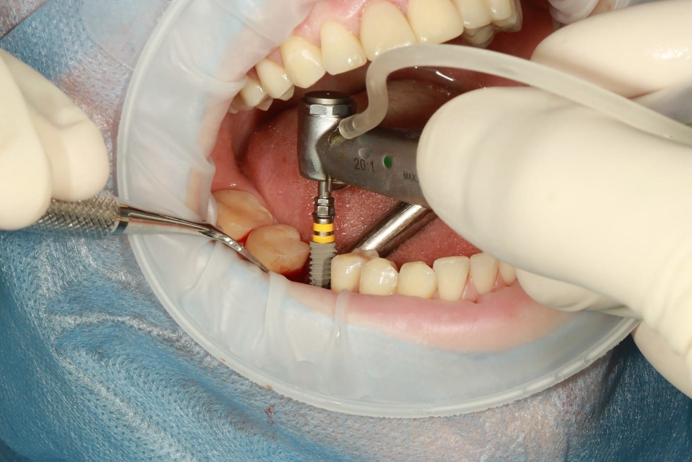 Îngrijirea ulterioară a implanturilor dentare