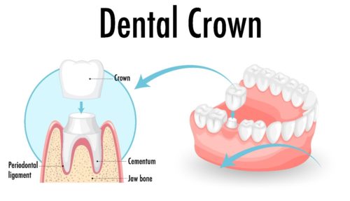 O coroană dentară este un dispozitiv protetic