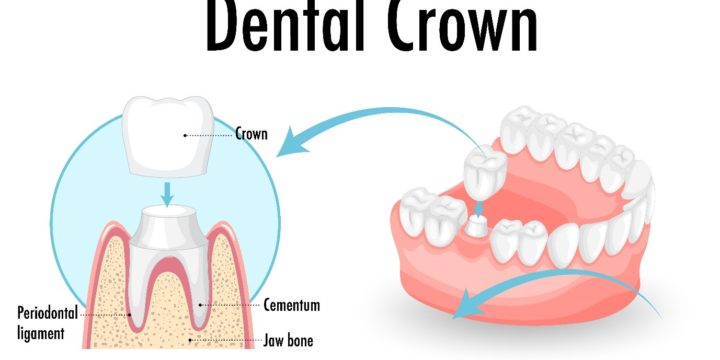 Când ar trebui să iei în considerare o coroană dentară?