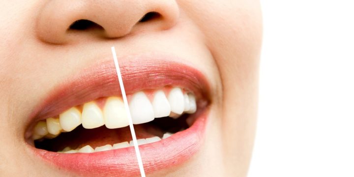 Tratamente inovatoare pentru albirea dinților